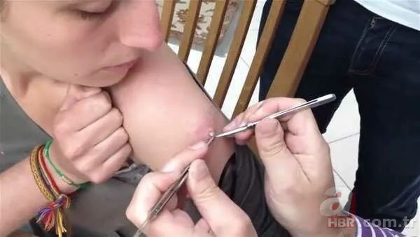 Genç kadının kolundan çıkanlar şoke etti 19