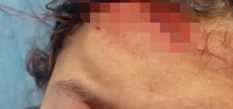 Asiye Ateş olayı sıcaklığını korurken bir kötü haber de Kastamonu'dan geldi! Sokak köpekleri genç kızın yüzünü parçaladı