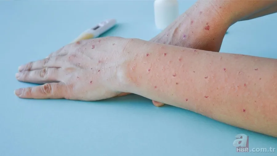 Maymun Çiçeği virüsü nedir, öldürür mü? Maymun Çiçeği hastalığının belirtileri neler, tedavisi var mı? Türkiye'de görüldü mü? 5