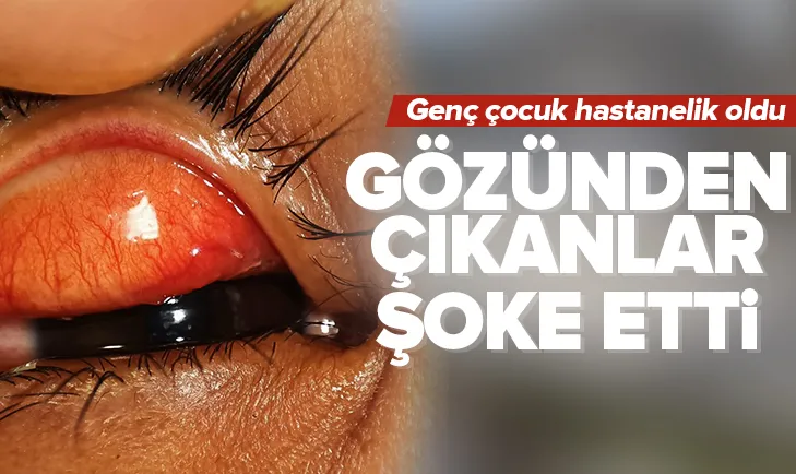 Çocuğun gözünden çıkanlar şoke etti