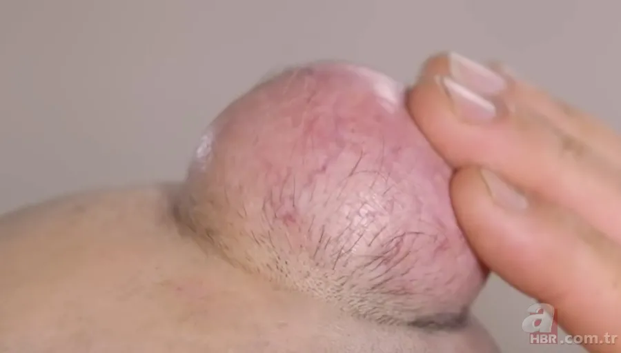 Sokağa şapka ile çıkıyordu! Başındaki şişlikten bakın ne çıktı 👩⚕️ Görenleri şaşkına çeviren olay 7