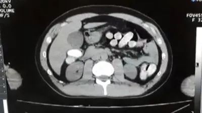 Midelerinden çıkanlar şaşırttı!