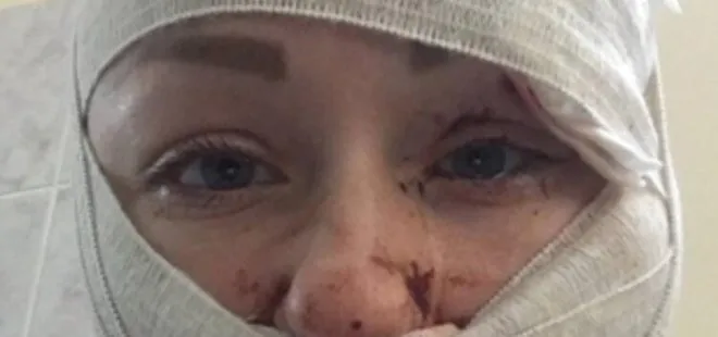 Mesut Öztürkmen boşanmak isteyen eşi Anna Butim’in yüzünü falçatayla bu hale getirdi