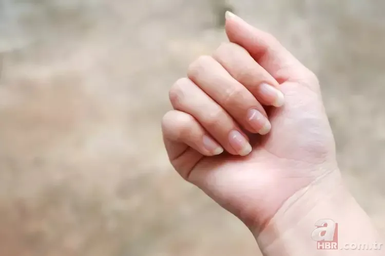 Tırnak diplerinizi kontrol edin! Belki de bu hastalıklardan birine sahipsiniz... 2