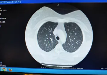 Korona hastalarının ciğerleri dehşete düşürdü