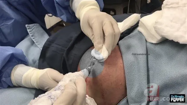 Boynundaki şişlikten bakın ne çıktı 👩‍⚕️ Operasyonu gerçekleştiren doktor bile şaşırdı | Bu kadar büyüyene kadar neredeydin