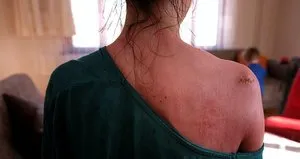 Kocası kaynar suyla haşlamıştı! Sözleri yürek dağladı