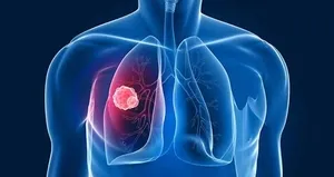 Akciğer kanserine ne iyi gelir?
