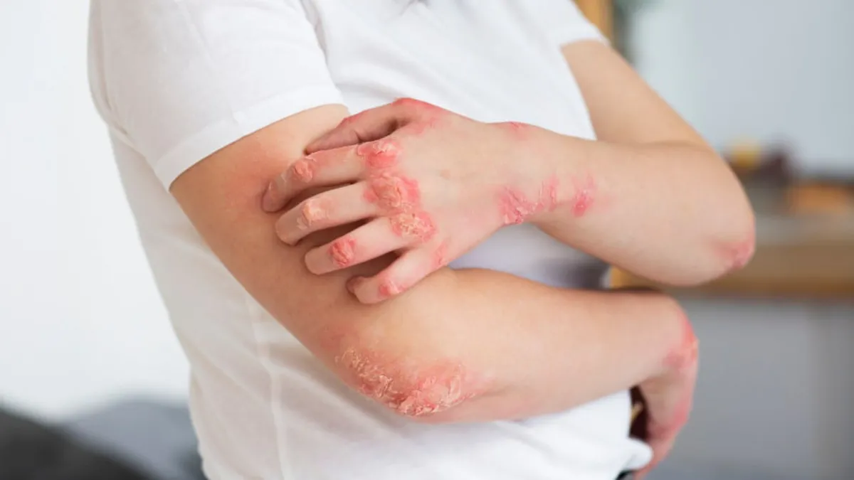 Sedef hastaları için öneriliyor: Semptomları yüzde 75 azaltıyor! İşte bilimsel araştırmanın şaşırtıcı sonuçları