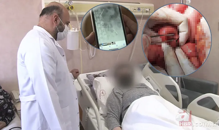 Amasya’da 22 yaşındaki genç kız karın ağrısı şikayetiyle hastaneye gitti! Gerçek şoke etti: Tam 5 kilo 11