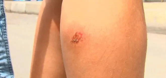 Son dakika: Avcılar’da sivrisinek kabusu: Çocuklarda yaralar oluştu! Mahalle sakinleri endişeli