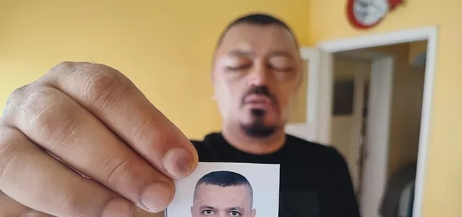 İnternetten aldığı şampuan hayatını kabusa çevirdi! Tanınmaz hale geldi