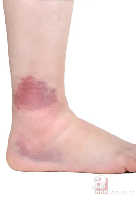 Ciddi sağlık sorunları belirtisi 9 ayak rahatsızlığı 4