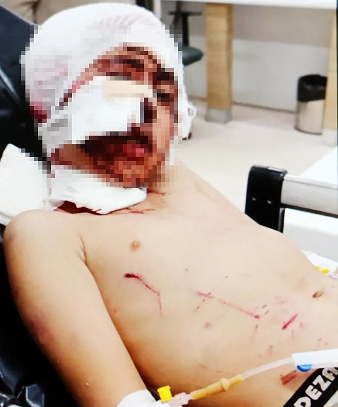 1741692123562.jpeg Erzurum'da 10 yaşındaki Murat Tutar başıboş köpeklerin saldırısına uğradı (DHA)