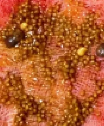 Aydın’da şoke eden olay! İnce bağırsağından 50 adet zeytin çekirdeği çıktı - 4
