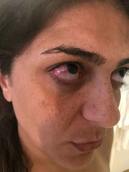 Deniz ve havuzda serinlemek isteyen tatilcilere 'kırmızı göz hastalığı' uyarısı - 5