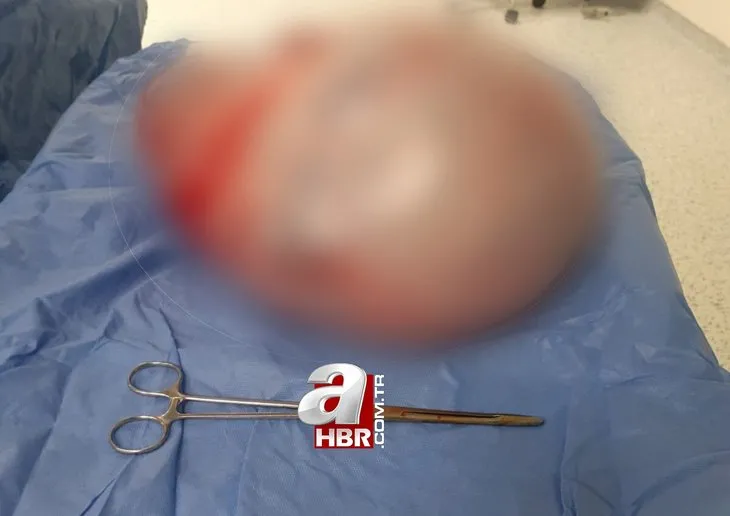 Giderek kilo almaya başladı soluğu doktorda aldı! Karnından çıkanı görünce gözlerine inanamadı 👨⚕️ Ameliyat sonrası 9 kilo zayıfladı