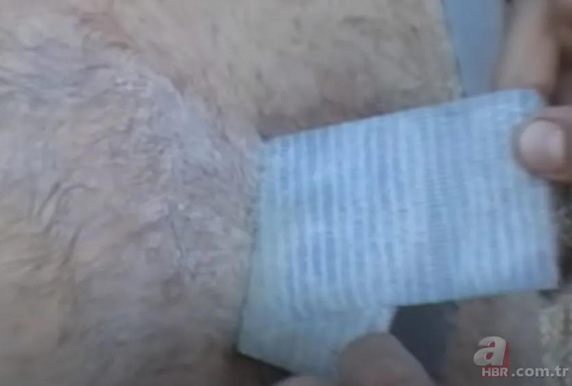 Sırtındaki yarayı sivilce zannetti ama gerçek dehşete düşürdü! Bakın içinden ne çıktı 10