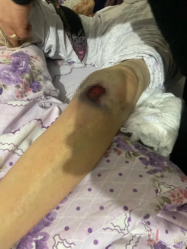Ankara'da bakıcı dehşeti! 91 yaşındaki kadının başından aşağı sıcak yemek döktü | Hastanede ölüm kalım savaşı veriyor 9