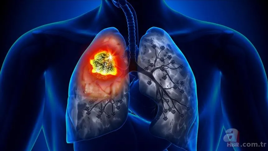 Eğer sabahları bunu yaşıyorsanız doktora gidin! Akciğer kanserinin ilk belirtisi uyandığınızda ortaya çıkıyor! Uzmanlar açıkladı 6