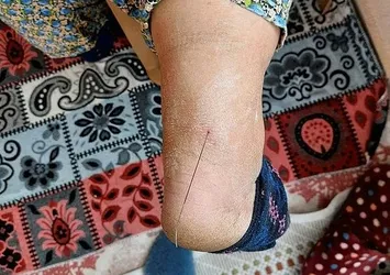 Topuğundan öyle bir şey çıktı ki! Muğla'da şoke eden olay: Tam 37 santim uzunluğunda...