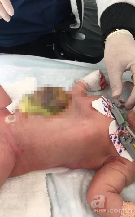 İç organları dışarıda doğmuştu! Miray bebek sağlığına kavuştu