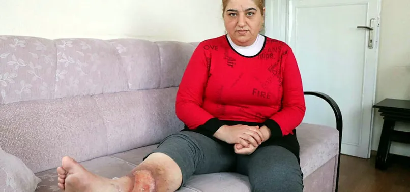 Sivilceyi önemsemedi, bacakları kesilecek duruma geldi