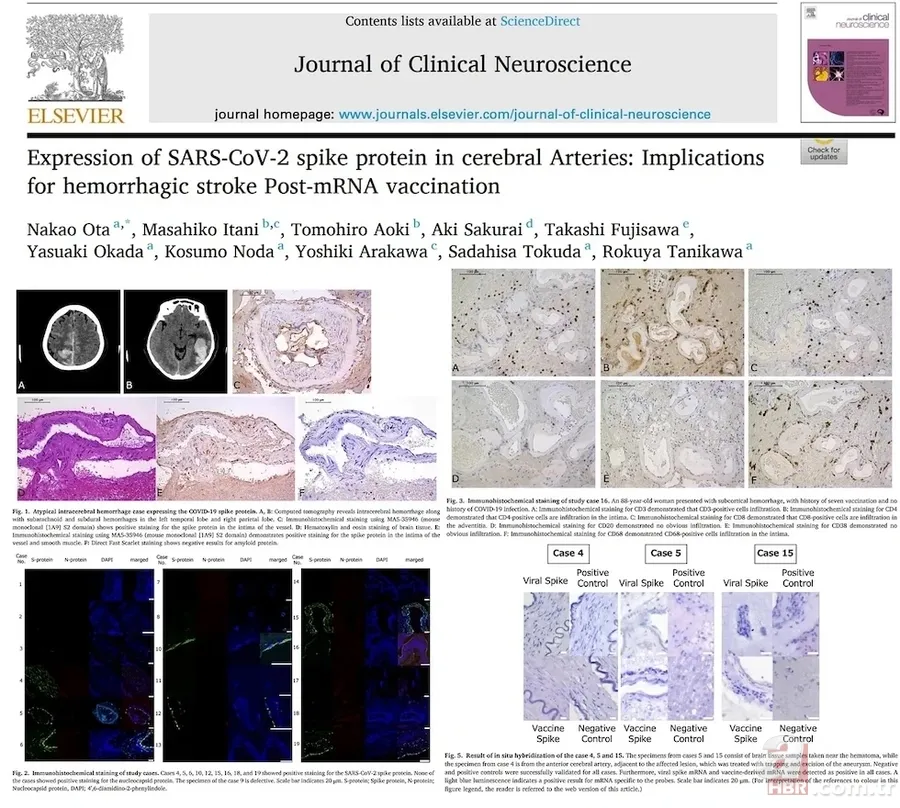 Felç riski COVID-19 aşısıyla artıyor mu? 100 binden fazla kişide görüldü: 17 ay hücrelerde birikerek... 2
