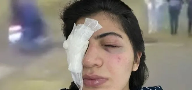 Mersin’de üniversiteli kızın başına gelenler dehşete düşürdü! Yüzüne sıvı attılar: Gözümü açamıyorum