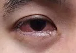 Göz alerjisi neden olur?