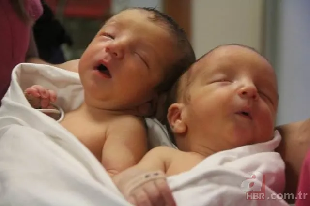 Yapışık ikizler dünyaya geldi 4