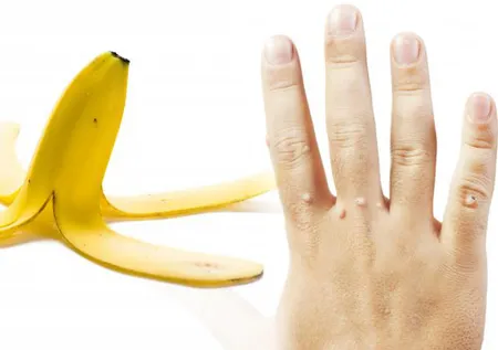 Muz kabuklarıyla o sorundan kurtulun! Meğer tedavisi çok kolaymış...