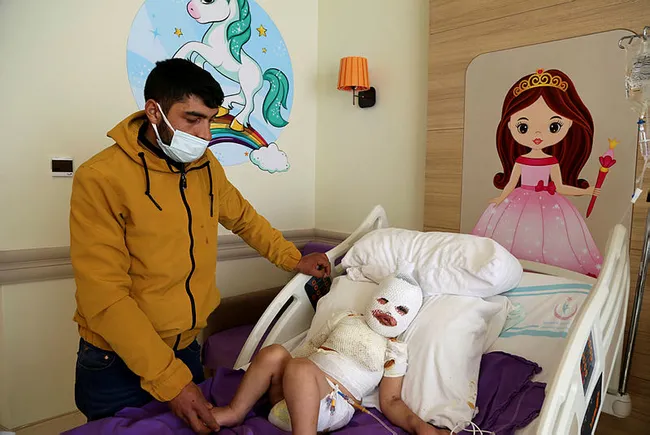 Kars’ta üstüne kaynar su dökülen 2 yaşındaki Hamit’in vücudu sargılarla kaplandı - 1