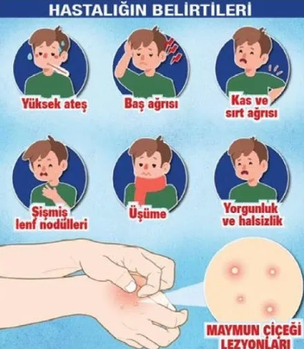 Maymun çiçeği virüsünün belirtileri nelerdir? Ölüm riski düşük ama çok acı çektiriyor | Maymun çiçeğinin iyileşme süreci ne kadar?