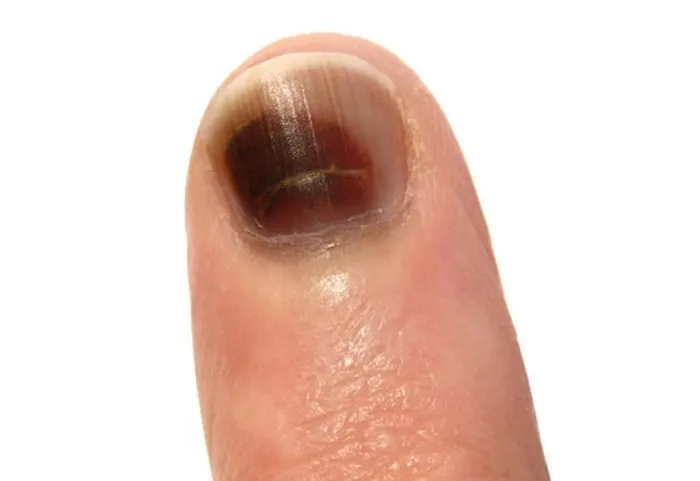 Tırnaktaki siyah lekelere dikkat! Hastalık habercisi olabilir