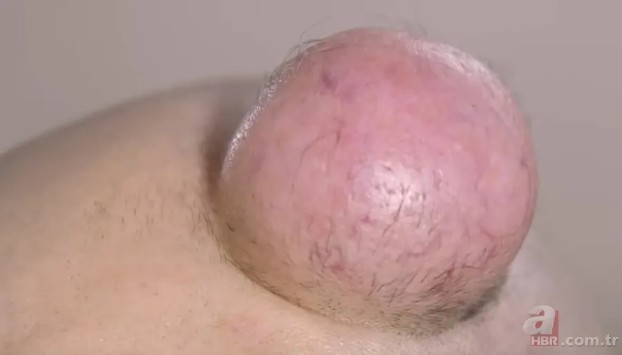 Sokağa şapka ile çıkıyordu! Başındaki şişlikten bakın ne çıktı 👩⚕️ Görenleri şaşkına çeviren olay 10