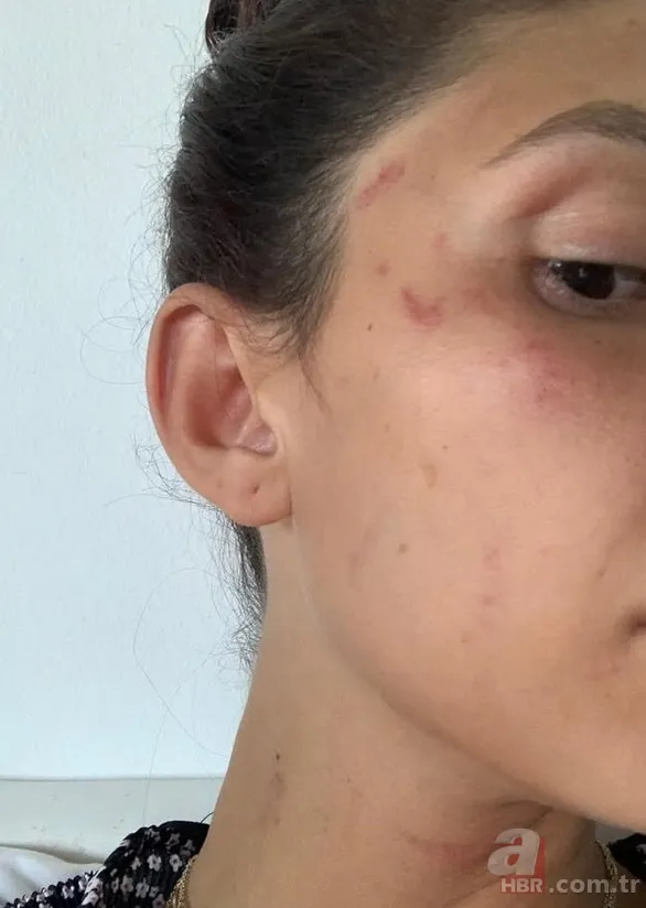 Can Yaman'ın şiddet gören sevgilisi kanlar içinde paylaştı! "Gerçekleri konuşma zamanı" 4