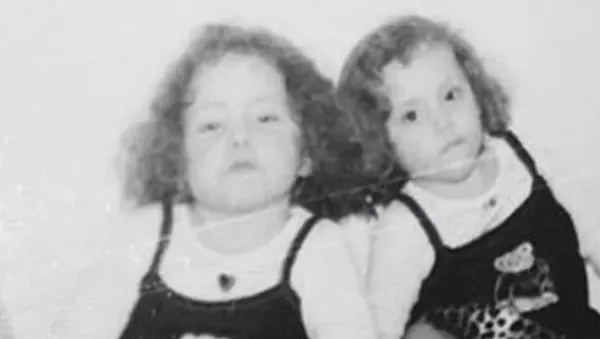 Kaybettiği yapışık ikizinin hayalini gerçekleştirdi! Hikayeleri Yürek bukrtu