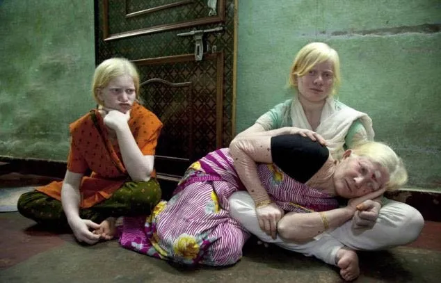 Dünyanın en büyük ’albino’ ailesi!