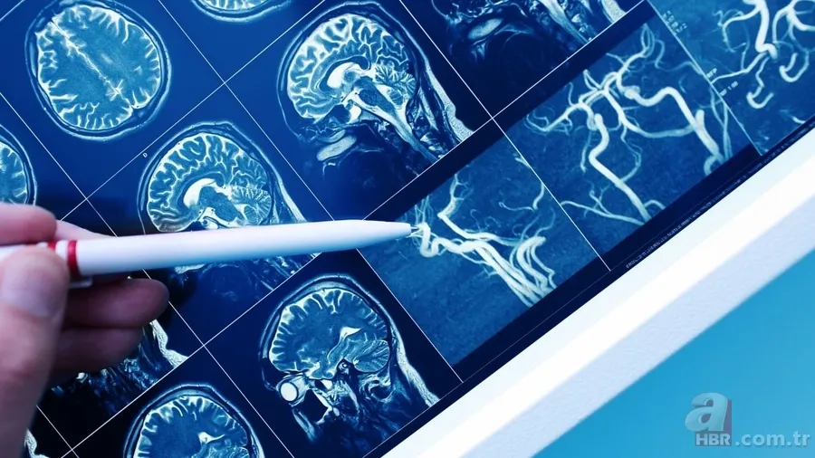 Bu gen bozulursa şizofreni başlıyor olabilir! GRIN2A araştırması gündemde 2