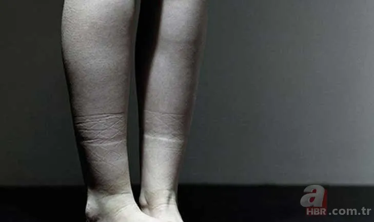 Çorap ayak bileğinizde iz bırakıyorsa... Vücudunuz sinyal veriyor olabilir