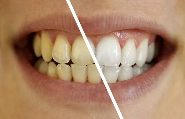 Doğal diş beyazlatma yolları! Doğal yöntemlerle diş beyazlatma!