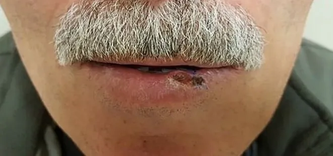 Ordu’da 62 yaşındaki adamın uçuk sandığı dudak yarası kanser çıktı