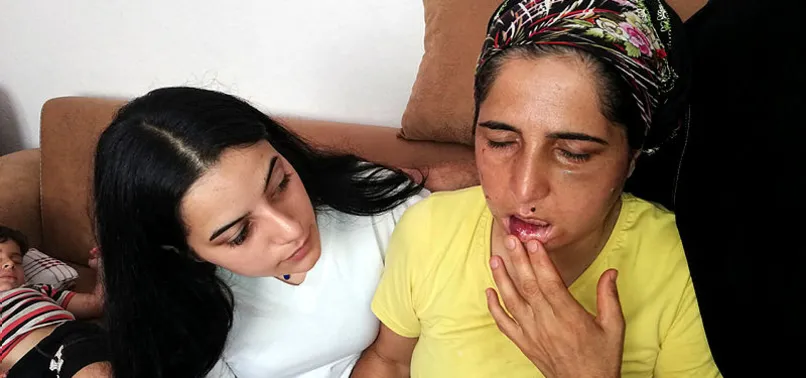 Hatay'da yaşayan Hatice Hanım 22 yıldır eşinden şiddet görüyor