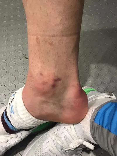 Trabzonspor’un yıldızı Sörloth’un ayağı delindi!