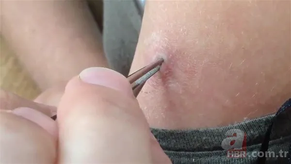 Kolundaki sivilceden böcek çıktı 👩⚕️ Doktora gidince şoke oldu | Cımbızla çektikçe içi gitti 7