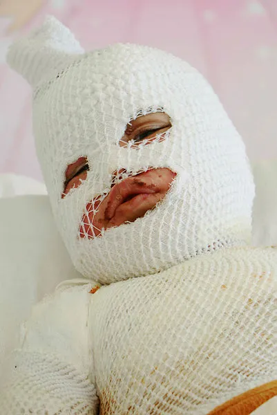 Kars’ta üstüne kaynar su dökülen 2 yaşındaki Hamit’in vücudu sargılarla kaplandı - 6