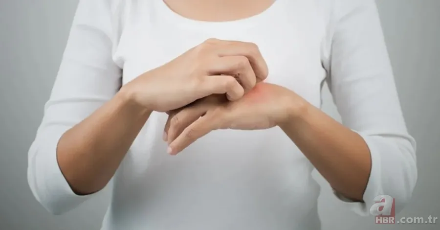 Uyuz hastalığı nedir, belirtileri neler? İnsandan insana uyuz nasıl geçer, kaşıntıya ne iyi gelir, tedavisi var mı? 4