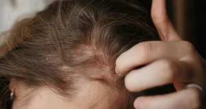 Egzama belirtileri nelerdir?