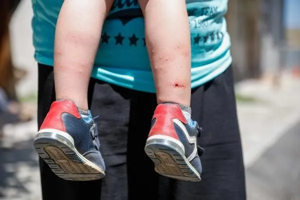 Isırdığı anda beyni küçültüyor! İstanbul'da 'Aedes' tehlikesi